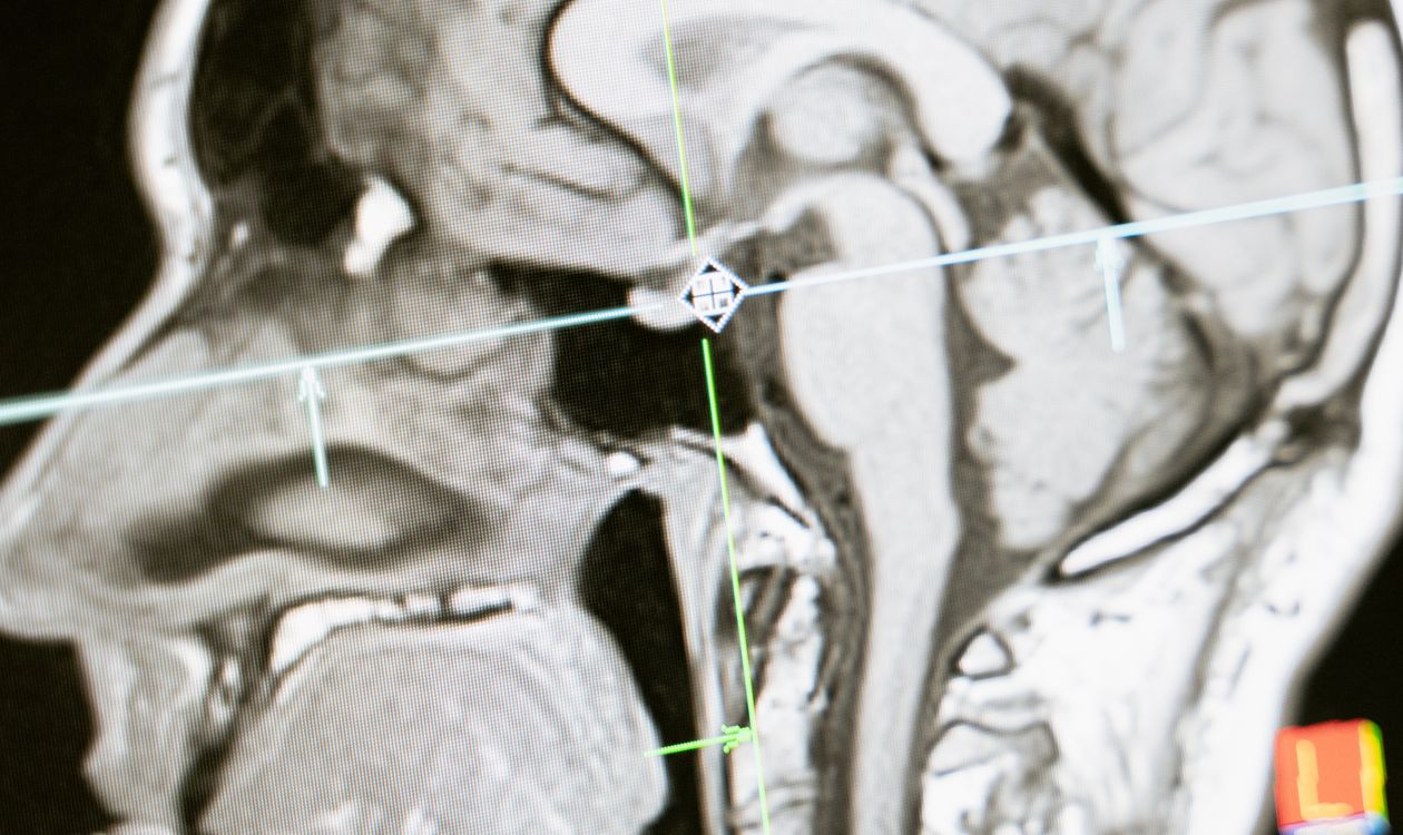 סריקת MRI של המוח — הדמיה נוירולוגית באבחון טרשת נפוצה | PainFree